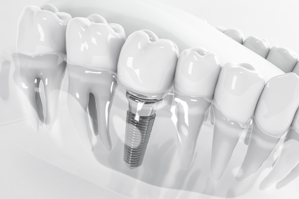 Czy warto zdecydować się na pełną odbudowę na implantach?
