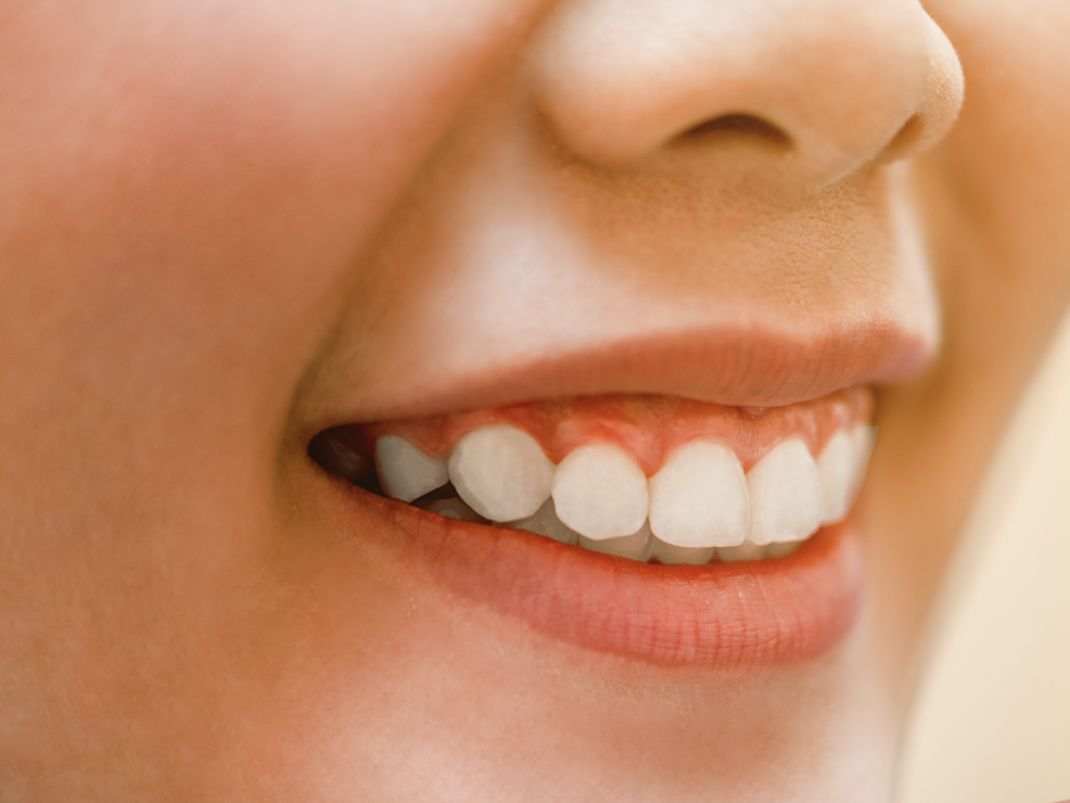 Gummy smile - jak pozbyć się uśmiechu dziąsłowego? | Komplet Stomatologia