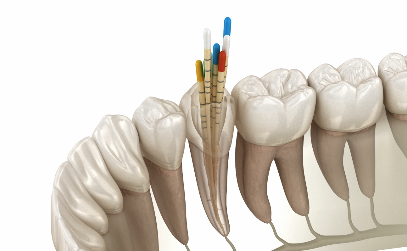 Powtórne leczenie kanałowe (re-endo) – na czym polega? | Komplet Stomatologia