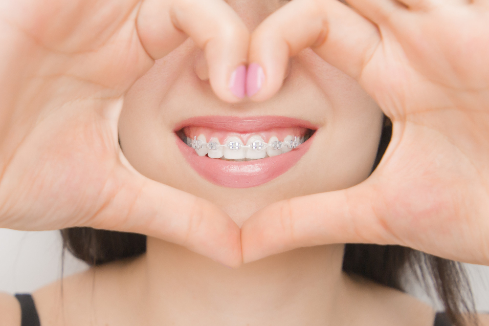 Aparat ortodontyczny – rodzaje, zakładanie, przeznaczenie