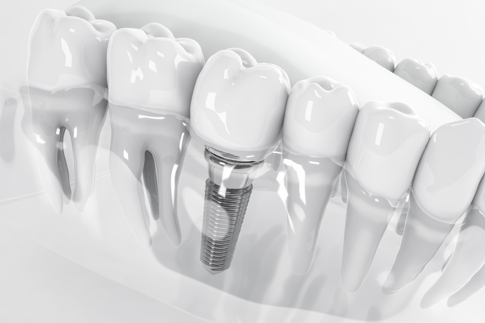 Dlaczego implanty zębowe są najlepszym rozwiązaniem?