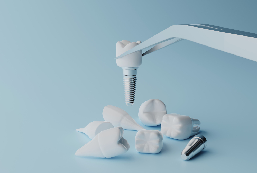 Implant zęba – dla zdrowia jamy ustnej