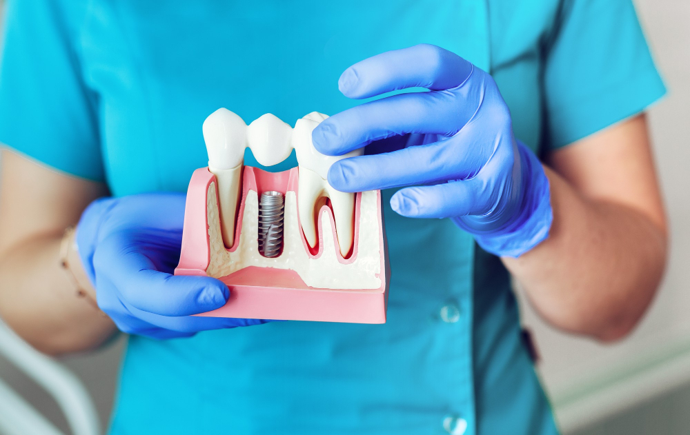 Dlaczego implanty dentystyczne mogą być najlepszym sposobem wymiany zębów