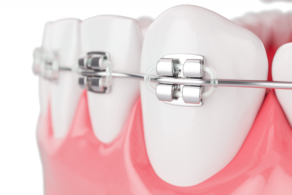 Aparat ortodontyczny – czy warto?