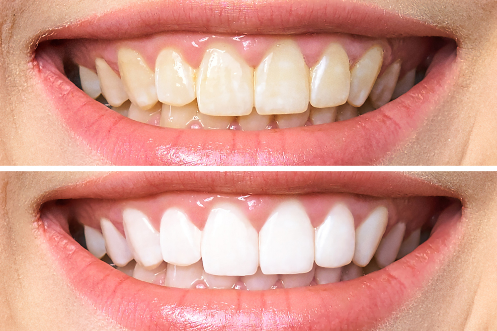 Jak działa wybielanie zębów?