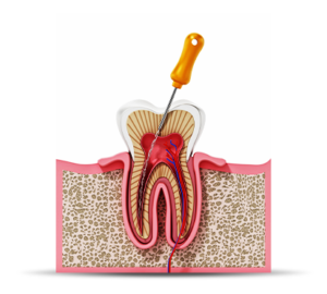Primary root canal treatment