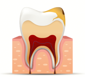 Restorations of permanent teeth, composite
