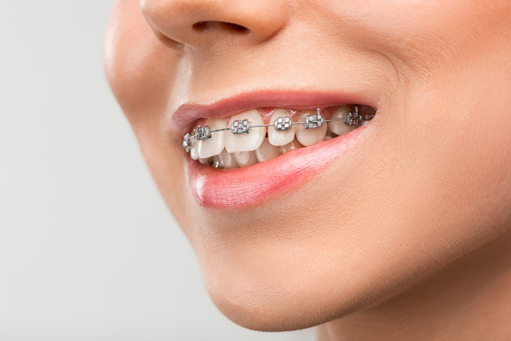Kiedy można ściągnąć aparat ortodontyczny?
