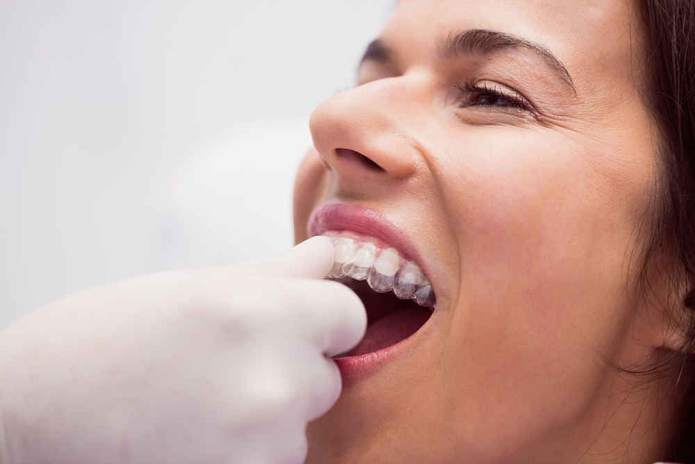 Korekcja zgryzu: Dlaczego warto zadbać o prawidłowy układ zębów?